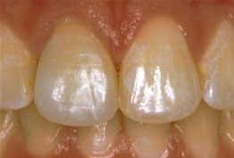 The image shows a close-up view of a person s teeth with a focus on a tooth undergoing dental treatment, possibly a filling or crown, against a background that appears to be a medical setting due to the presence of a pink oral tissue and a tongue visible in the upper left corner.