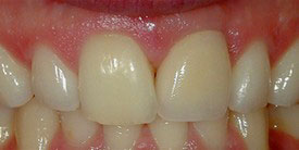 The image shows a close-up of a person s teeth with a focus on dental work, such as braces or orthodontic treatment, with a visible gap between two teeth.