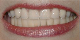 The image shows a close-up of a person s smile with white teeth and lipstick on their lips.