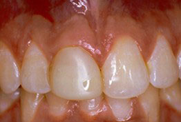 The image shows a close-up view of a person s teeth, with the focus on a partial denture or dental implant, which appears to be missing some teeth, set against a background that seems to be the interior of a mouth.