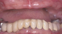 The image shows a close-up view of a person s mouth with yellowed teeth and visible gum disease, emphasizing dental hygiene concerns.